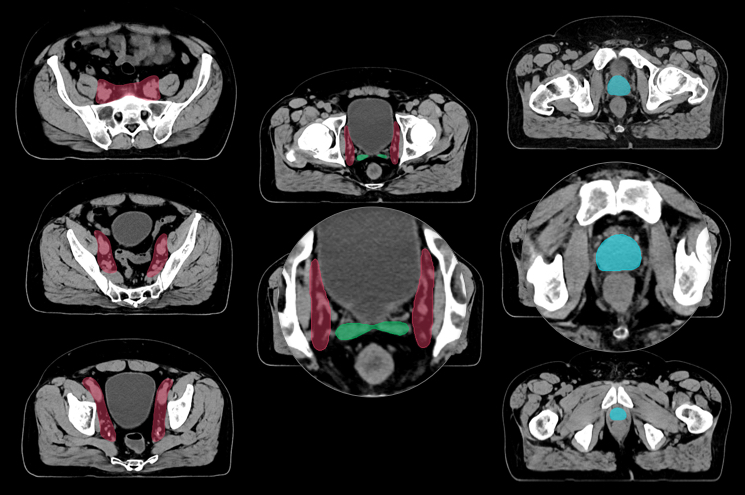 CTV Pelvis